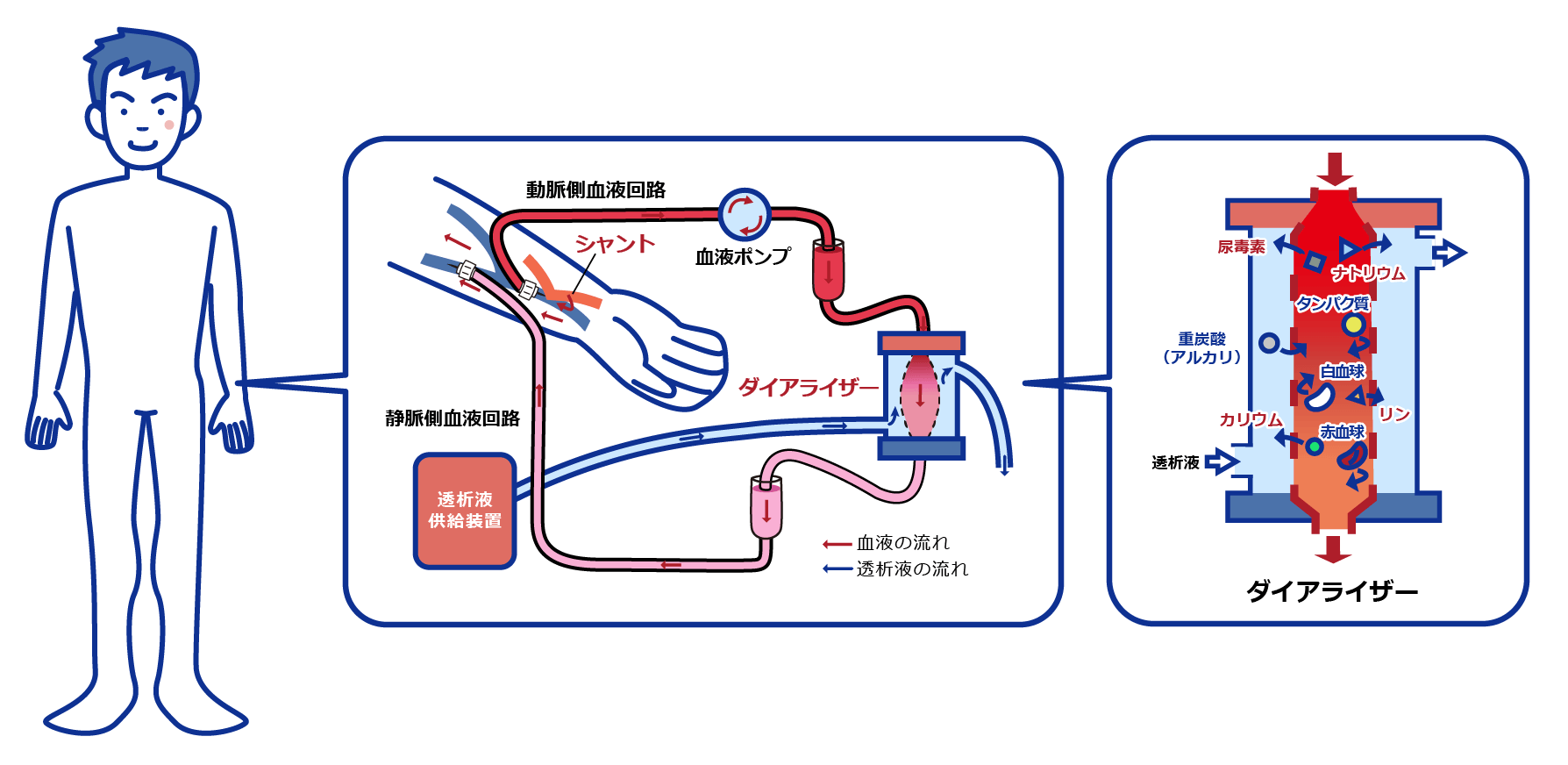 慢性腎臓病（CKD）の外科治療 | 慢性腎臓病 | ONO MEDICAL NAVI 一般・患者さん向け | 小野薬品